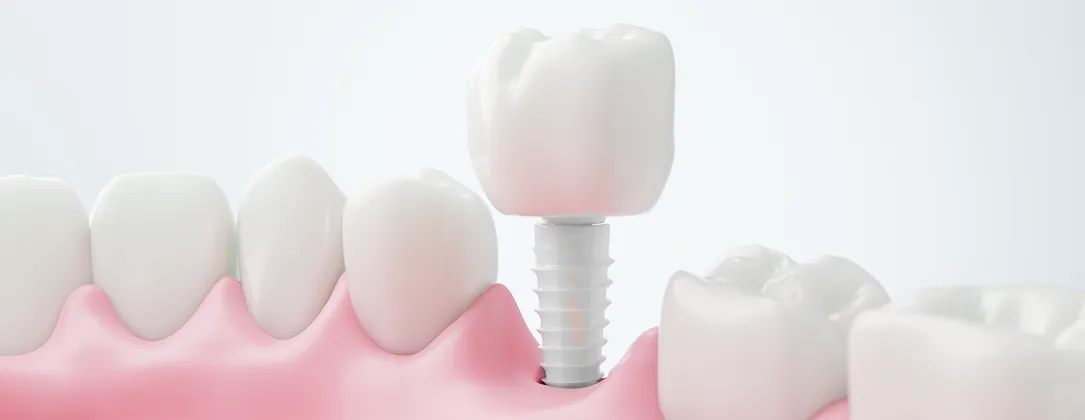 インプラントのイメージ